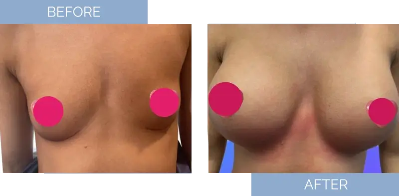 breast-augmentation-before-after-16