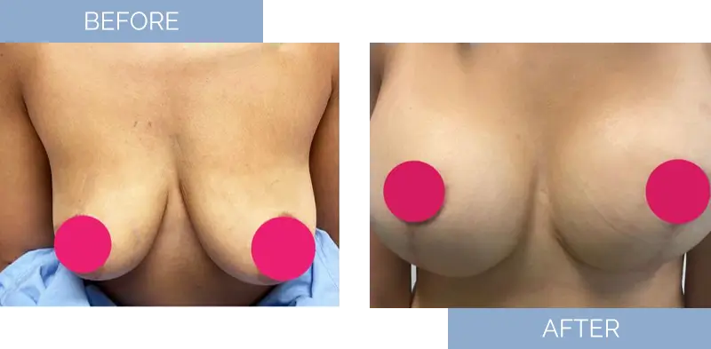 breast-augmentation-before-after-7