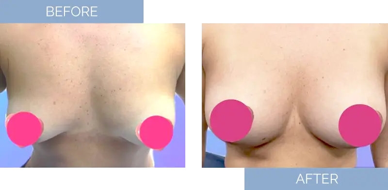 breast-augmentation-before-after-8