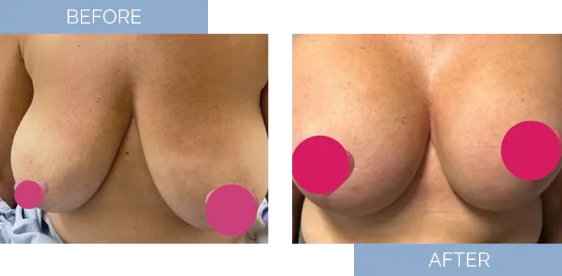 breast-augmentation-before-after-9