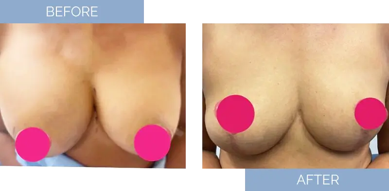 breast-augmentation-before-after-10