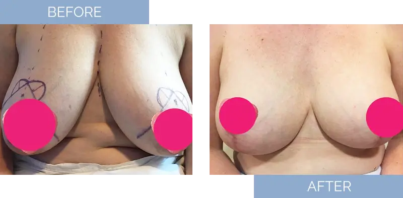 breast-augmentation-before-after-11