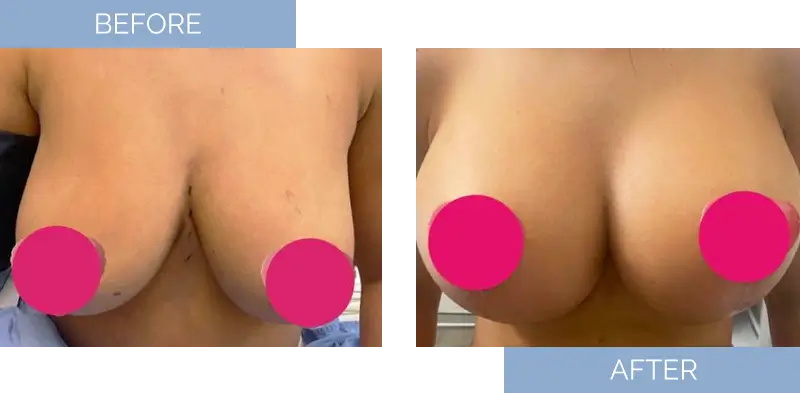 breast-augmentation-before-after-12