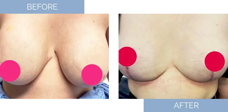 breast-augmentation-before-after-13