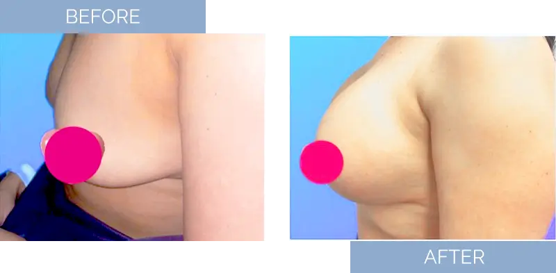 breast-augmentation-before-after-15