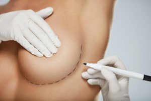 Exercise After Breast Augmentation planning