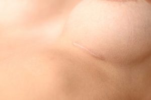 Exercise After Breast Augmentation scar