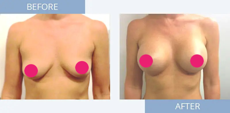 breast-augmentation-before-after-1