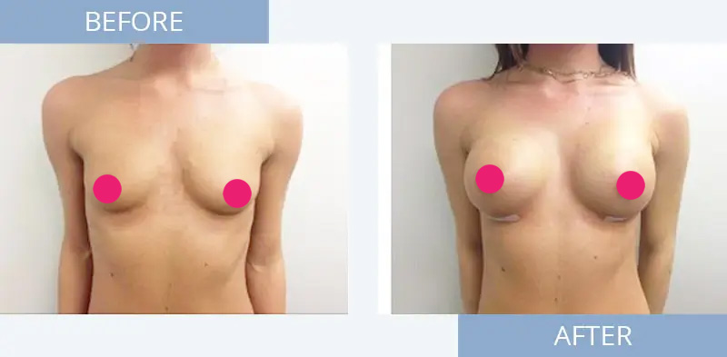 breast-augmentation-before-after-2