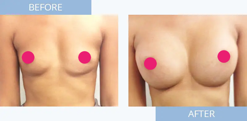 breast-augmentation-before-after-3