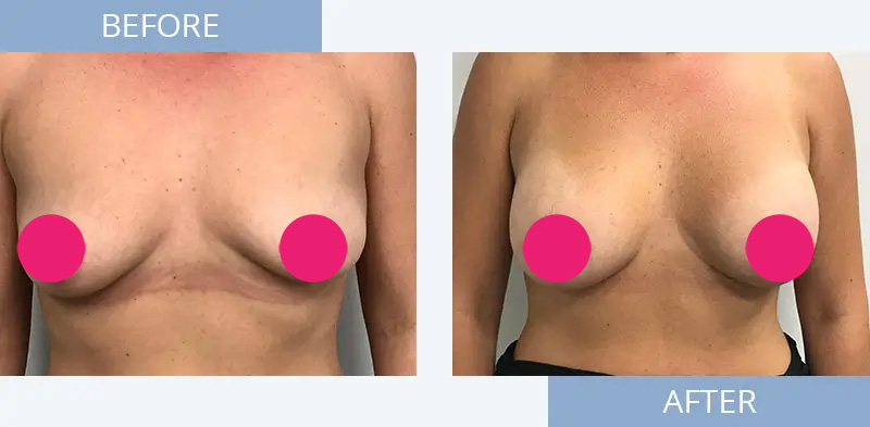 breast-augmentation-before-after-4