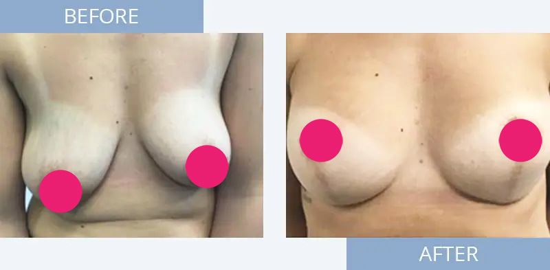 breast-augmentation-before-after-5