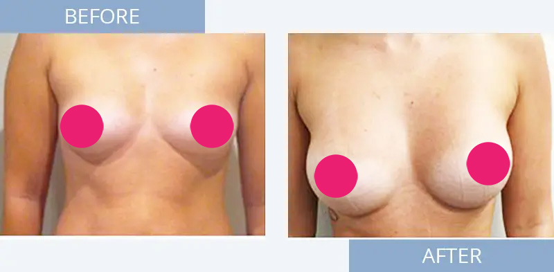 breast-augmentation-before-after-6